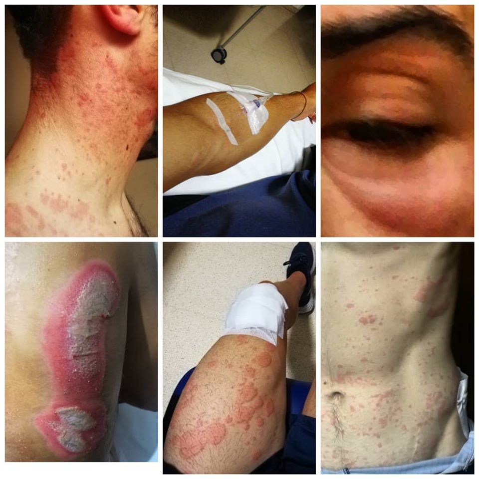 sergio-samitier-movistar-team-2020-urticaria